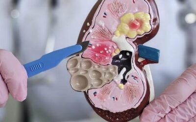 What to Expect After Surgery for Kidney Cancer