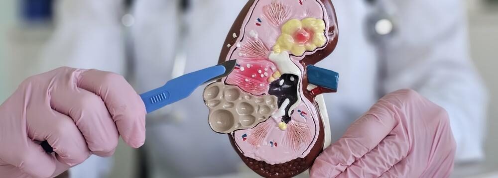 What to Expect After Surgery for Kidney Cancer