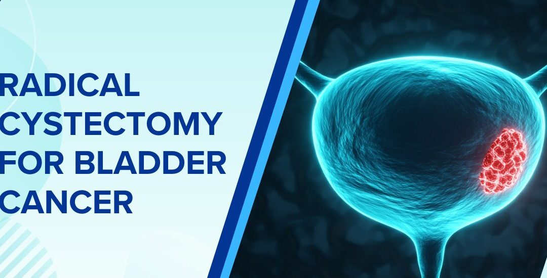 Radical Cystectomy for Bladder Cancer