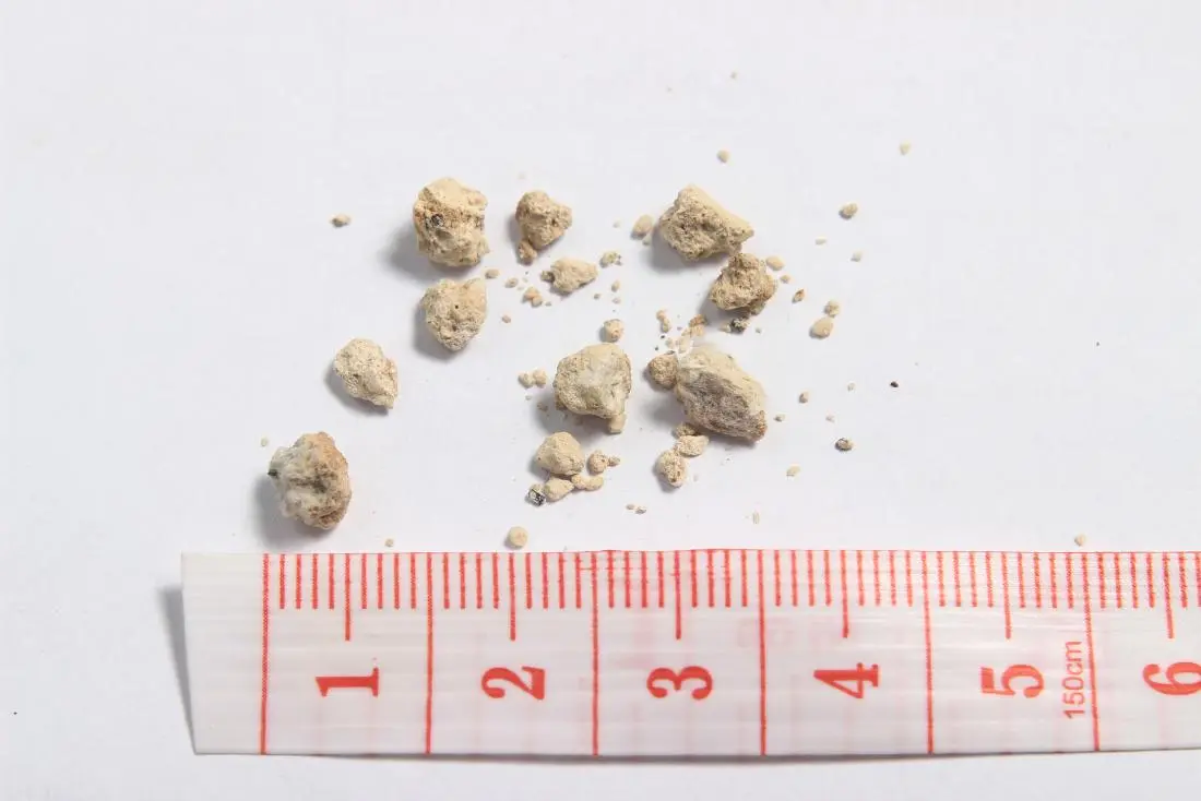 What kidney stone size actually needs surgery What kidney stone size actually needs surgery<br />