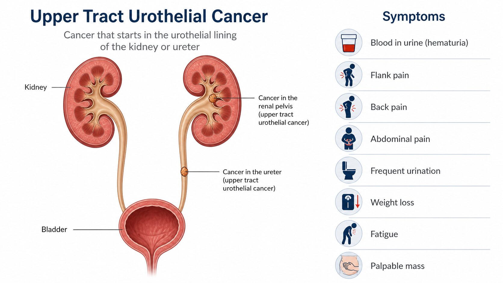 p2 Infographic: Upper Tract Urothelial Cancer diagram showing kidneys, ureter, and cancer in renal pelvis/ureter with a symptoms list on the right side.