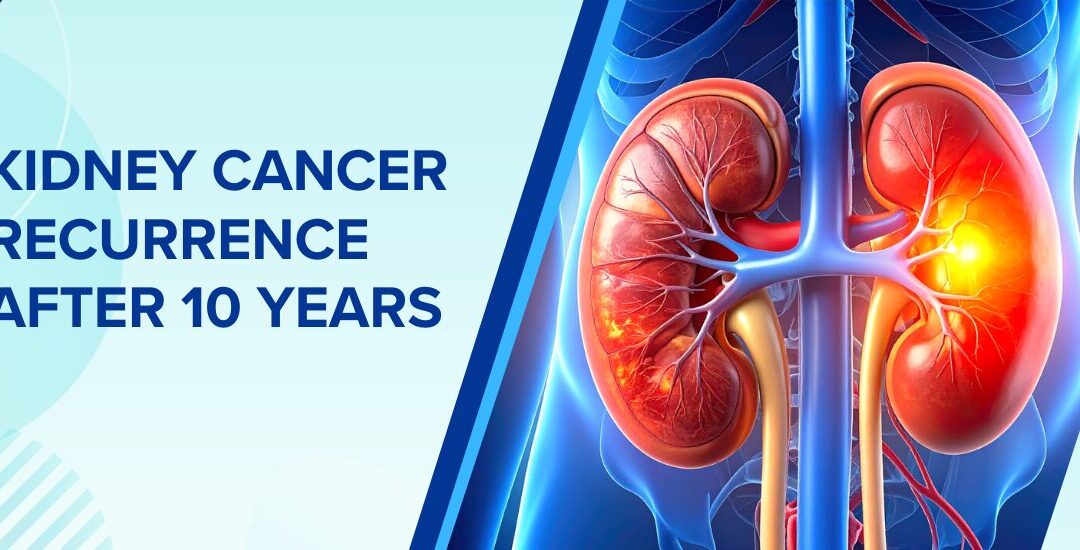 Kidney Cancer Recurrence After 10 Years