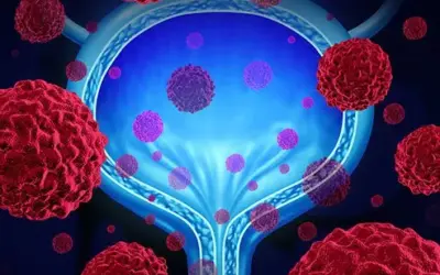 5 Warning Signs of Bladder Cancer