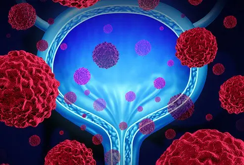 5 Warning Signs of Bladder Cancer