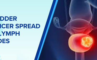 Bladder Cancer Spread to Lymph Nodes