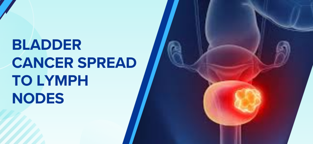 Bladder Cancer Spread to Lymph Nodes