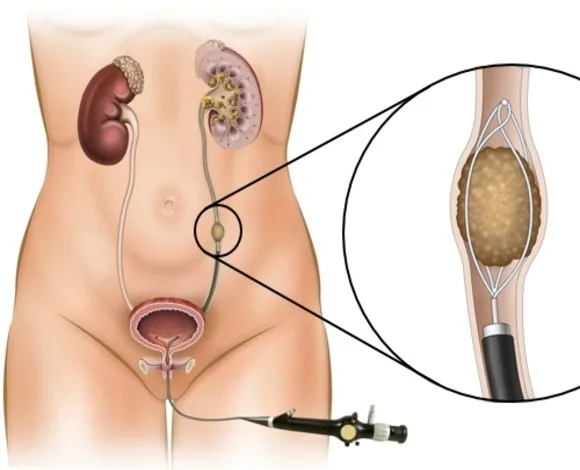 Illustration of an artificial urinary sphincter: a cuff around the urethra, a pump implanted in the scrotum, and a fluid reservoir to control urination.